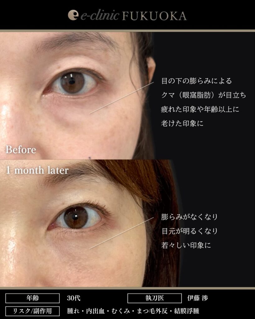 裏ハムラ法の症例写真 (92)