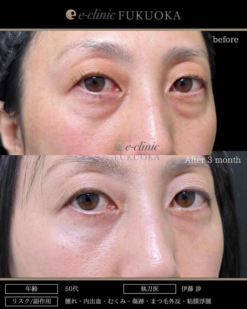 裏ハムラ法の症例写真 (92)