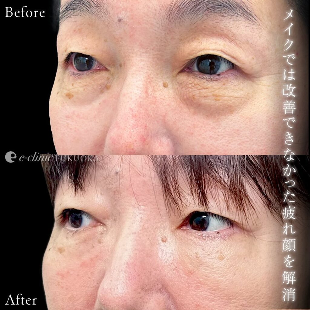 他院修正と表ハムラ法症例写真 (3)