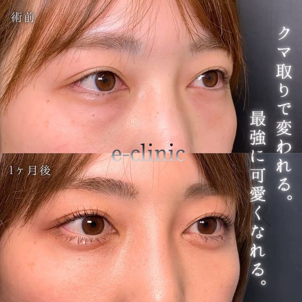 裏ハムラ法の症例写真 (19)