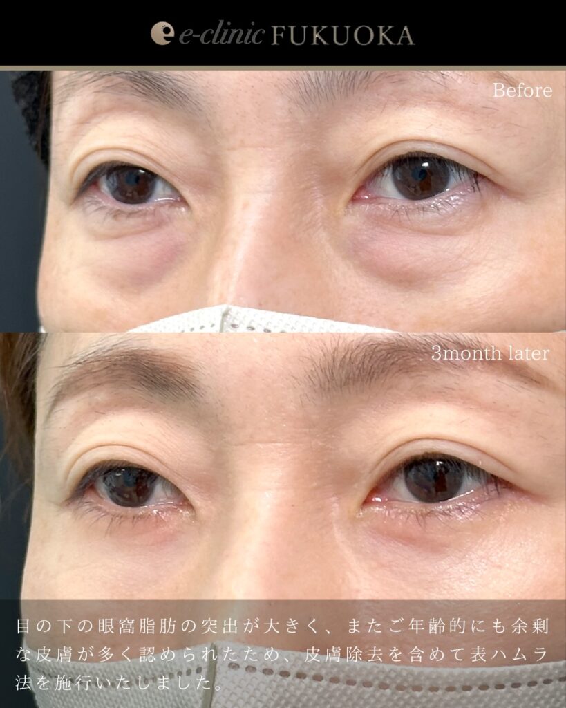 表ハムラ法の症例写真 (6)