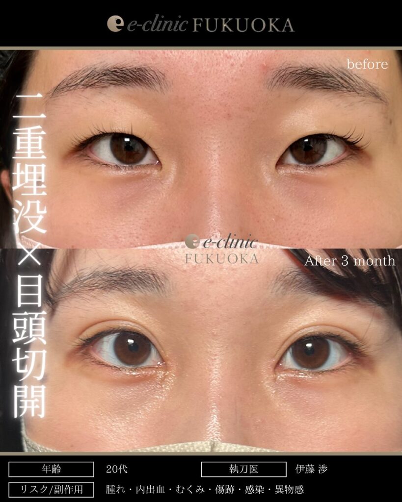 埋没法と目頭切開の症例写真 (4)