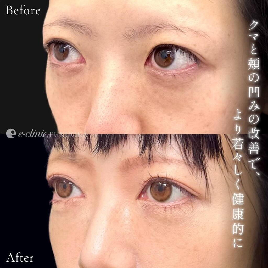 裏ハムラ法と目の下の脂肪注入の症例写真 (8)