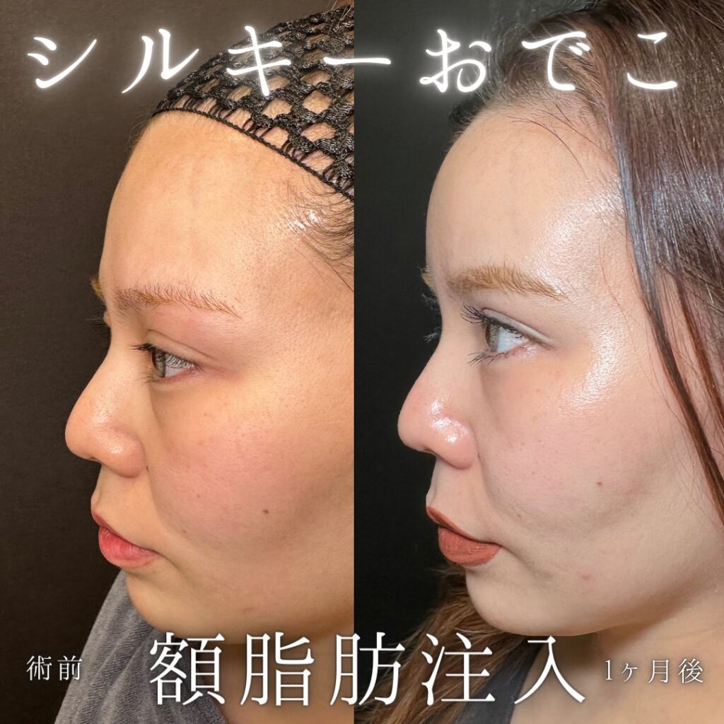 額の脂肪注入の症例写真 (2)