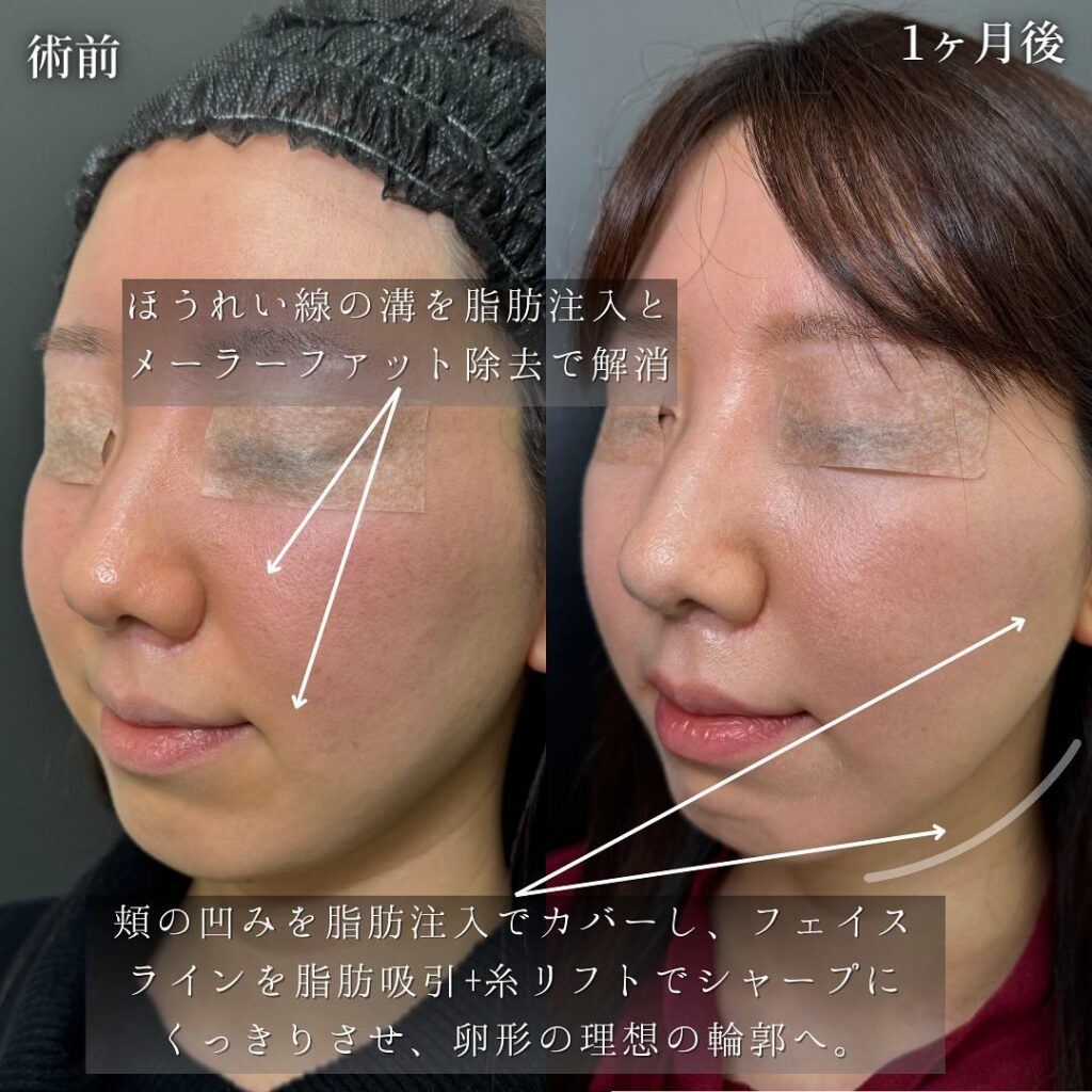 頬と顎下の脂肪吸引とジョールとメーラーファットと脂肪注入と糸リフトの症例写真 (2)
