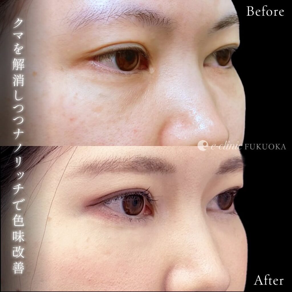 裏ハムラ法とナノリッチの症例写真 (15)