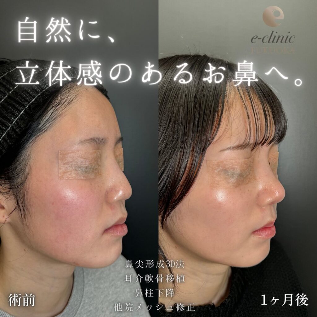 鼻尖形成と軟骨移植と鼻柱下降と他院修正の症例写真 (2)