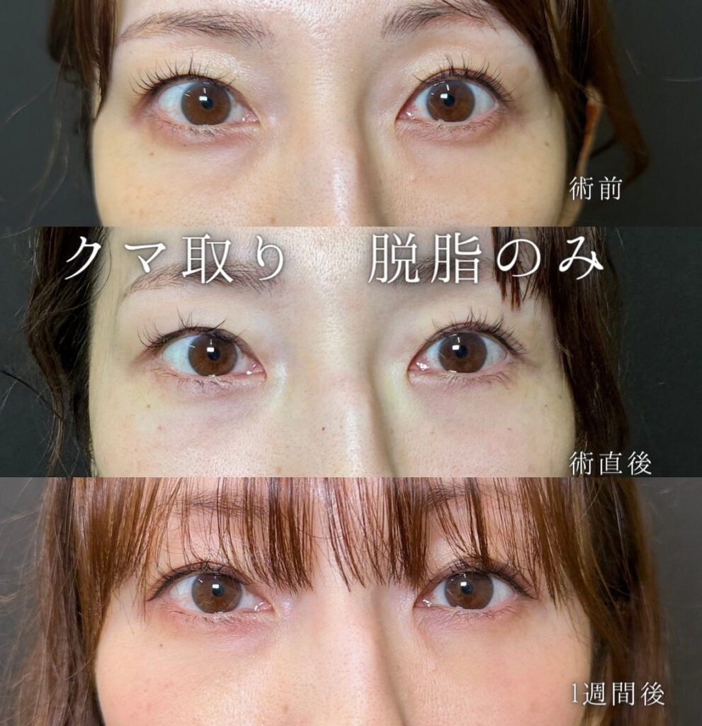 脱脂の症例写真 (2)