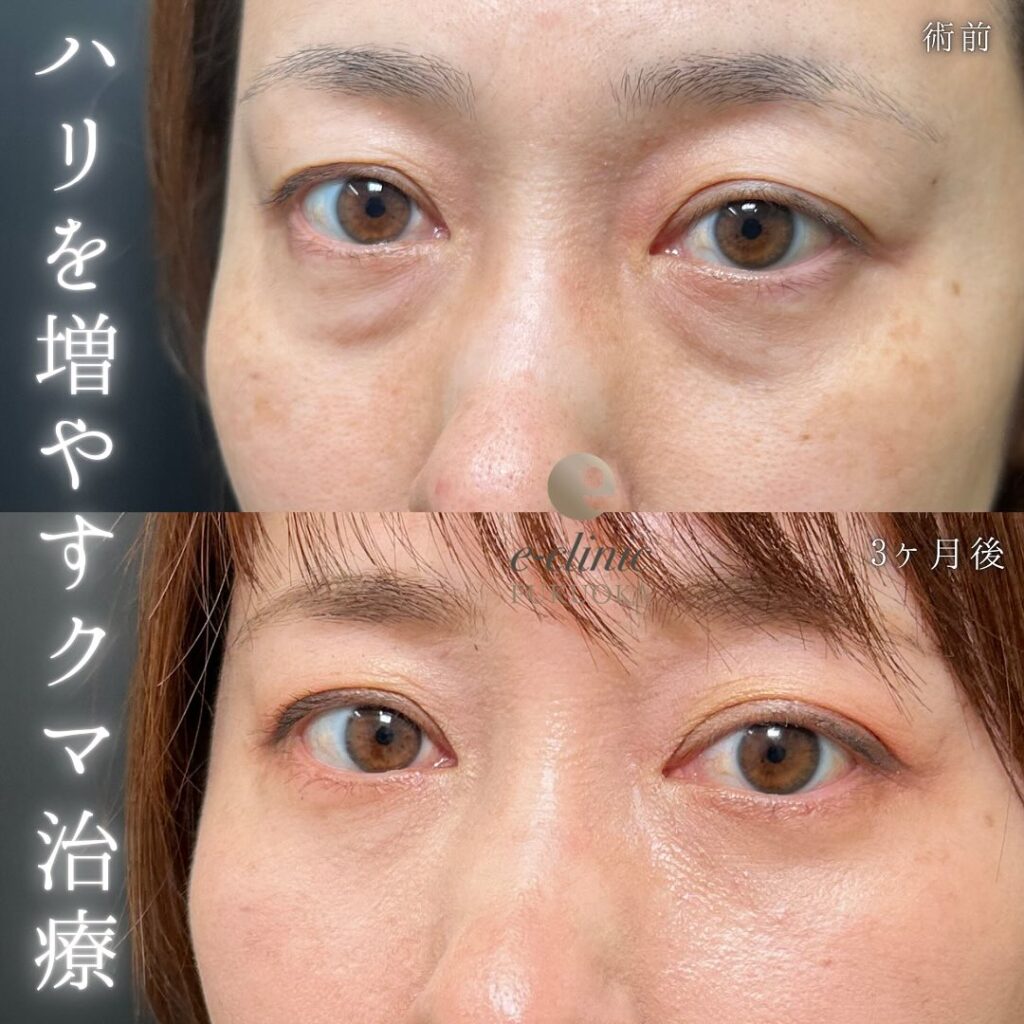 目の下のたるみ取りと裏ハムラ法と脂肪注入の症例写真 (2)