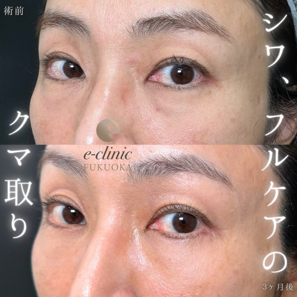 裏ハムラ法と脂肪注入の症例写真 (18)