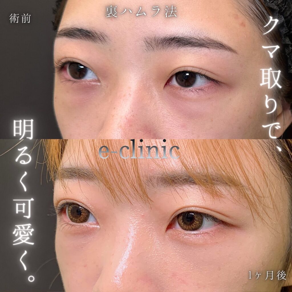 裏ハムラ法の症例写真 (45)