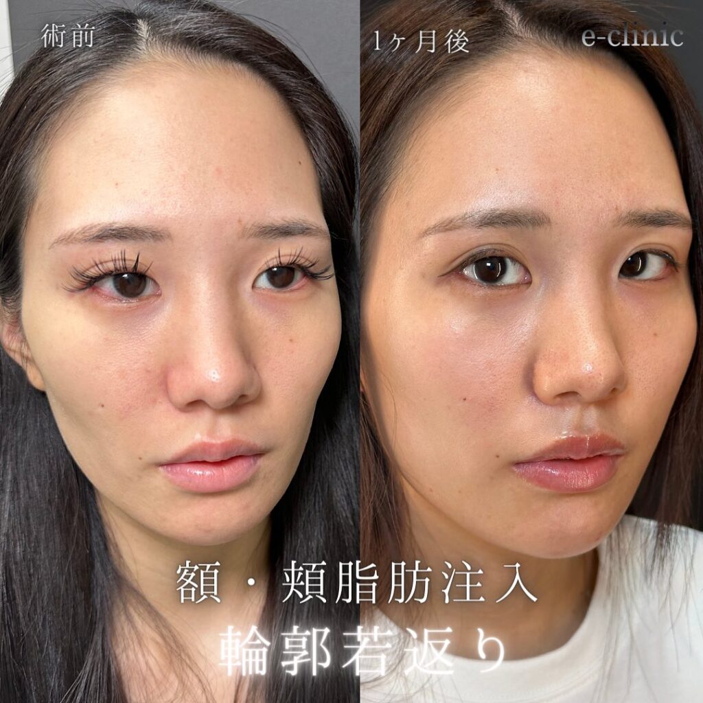 頬と額の脂肪注入と目尻切開の症例写真 (3)