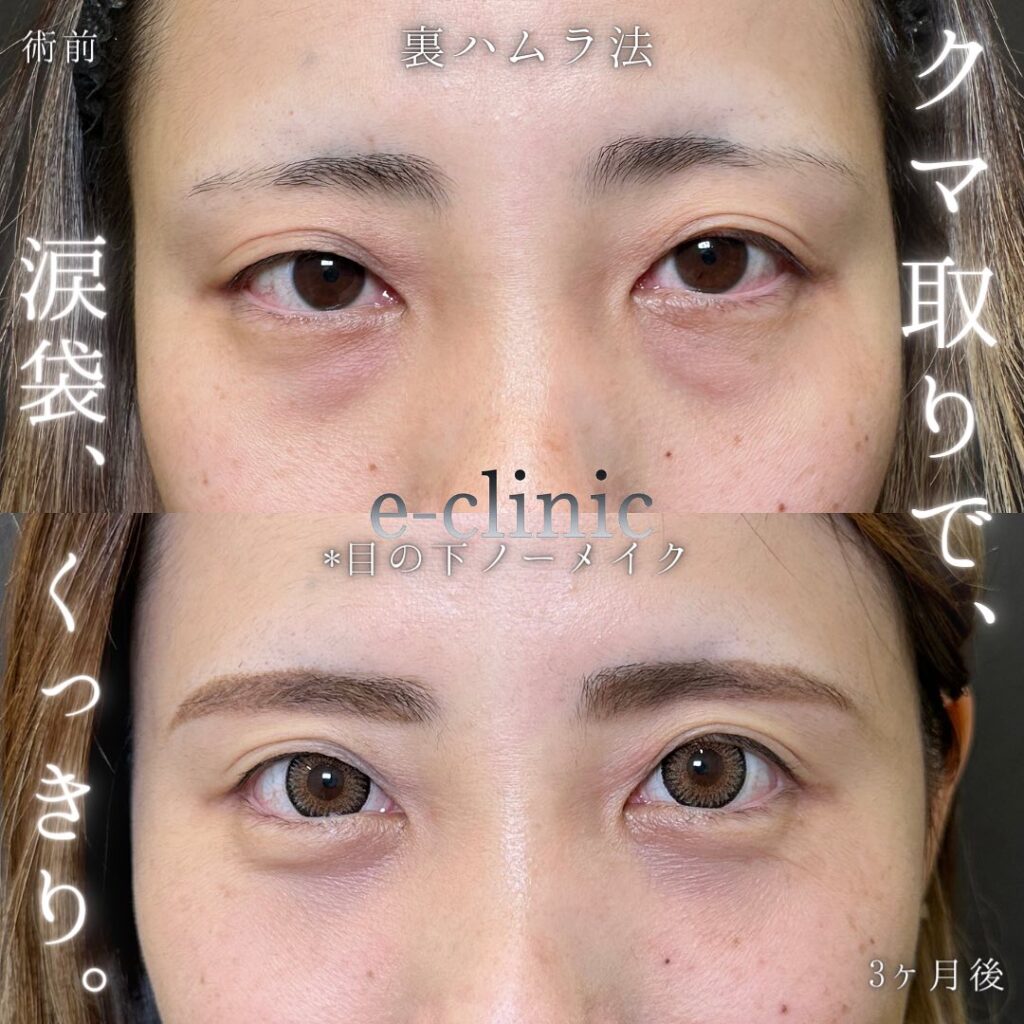 裏ハムラ法の症例写真 (56)