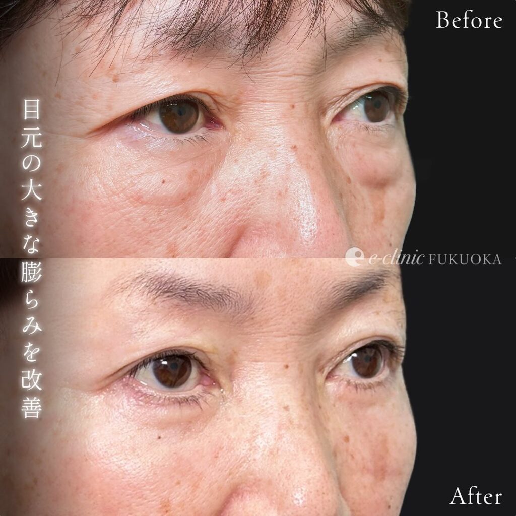 表ハムラ法の症例写真 (3)