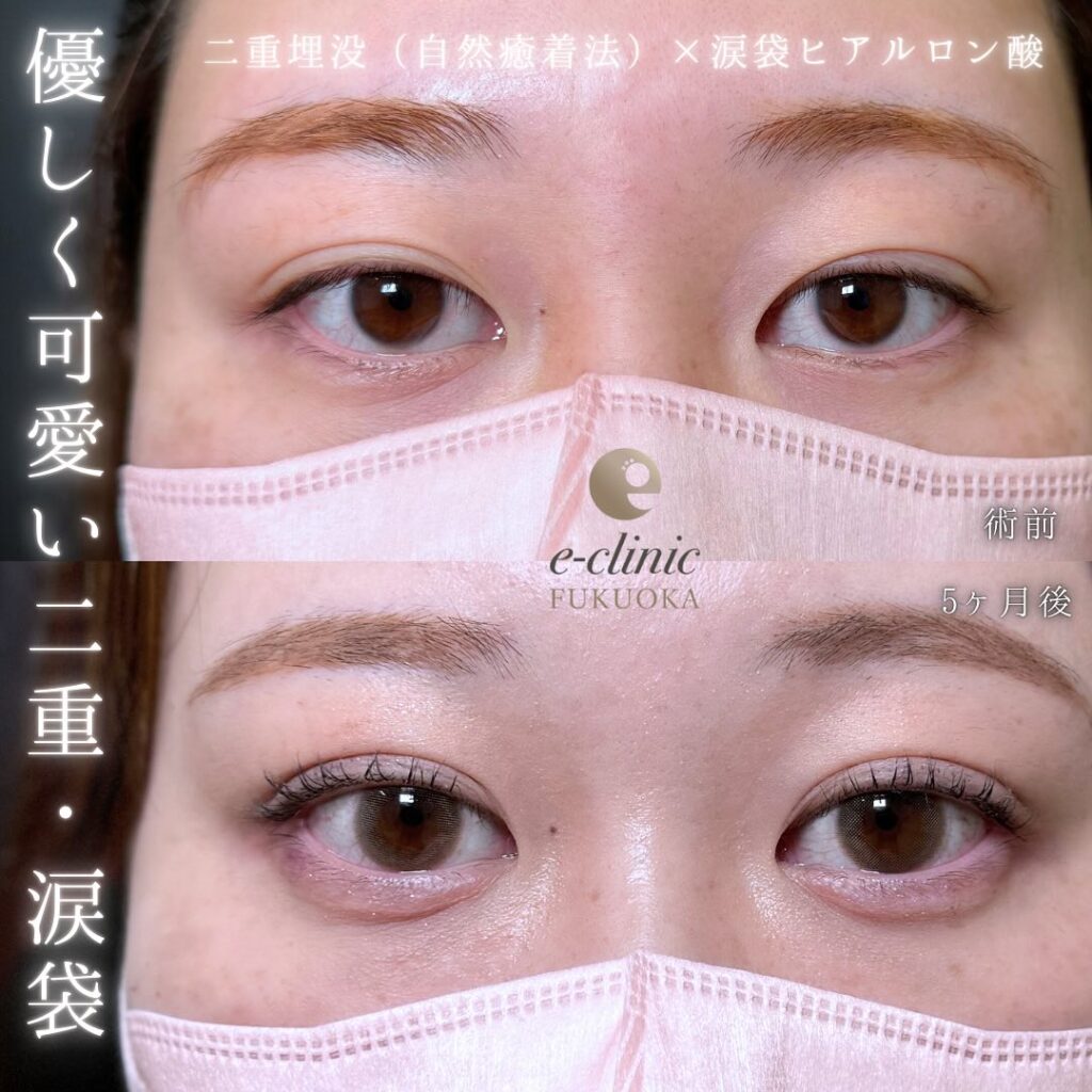 自然癒着法と涙袋のヒアルロン酸の症例写真 (1)