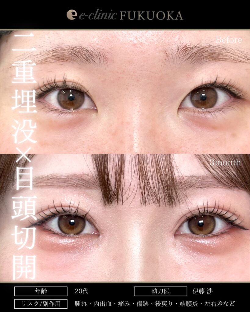 埋没法と目頭切開の症例写真 (9)