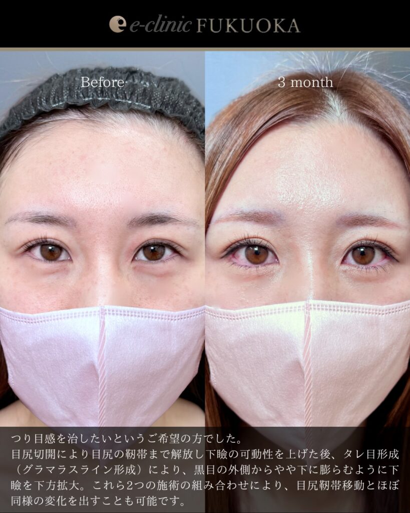 タレ目形成と目尻切開と脱脂とクマ取りの症例写真 (5)