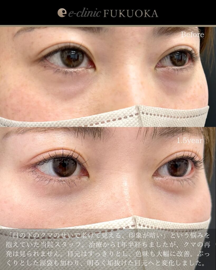 裏ハムラ法の症例写真 (97)