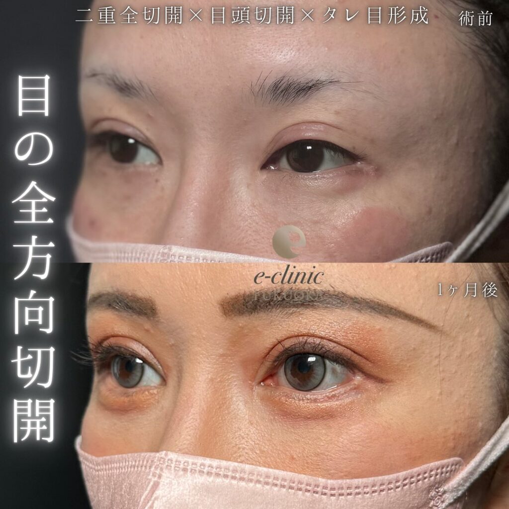 目の全方向切開の症例写真 (2)