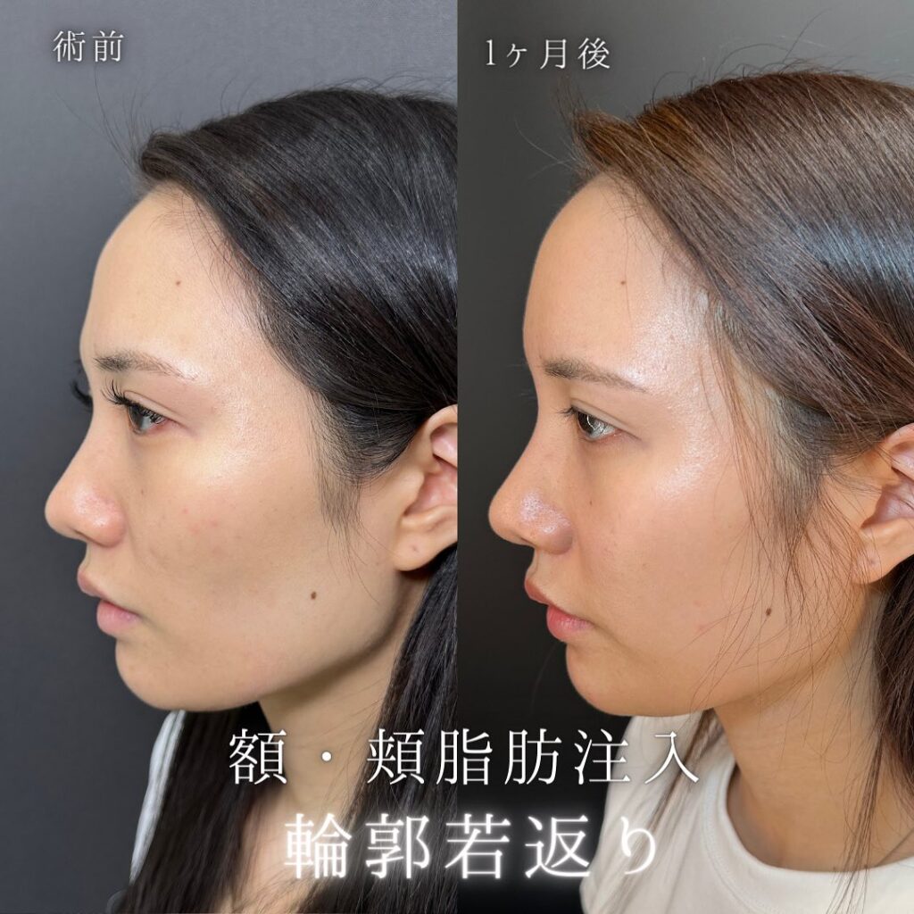 頬と額の脂肪注入と目尻切開の症例写真 (4)