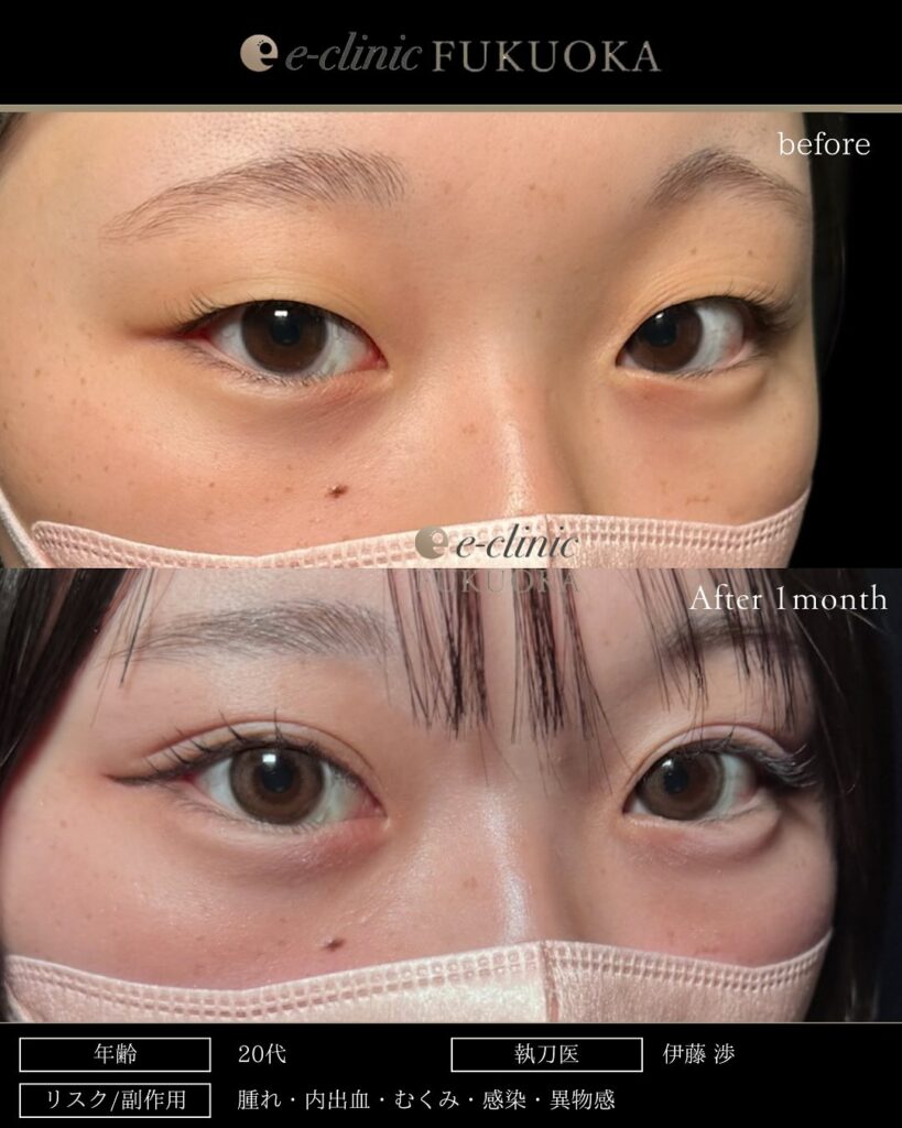 自然癒着法の症例写真 (14)