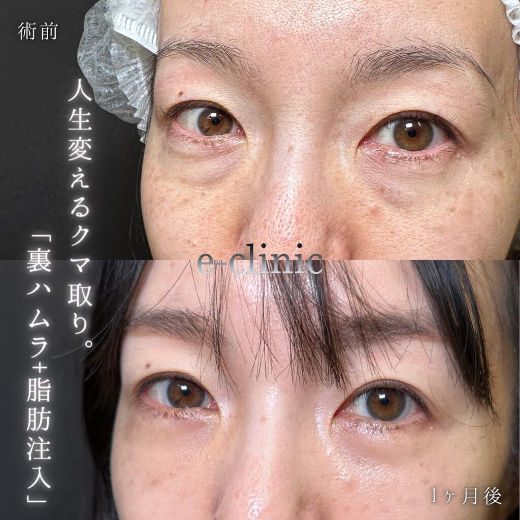 裏ハムラ法と脂肪注入の症例写真