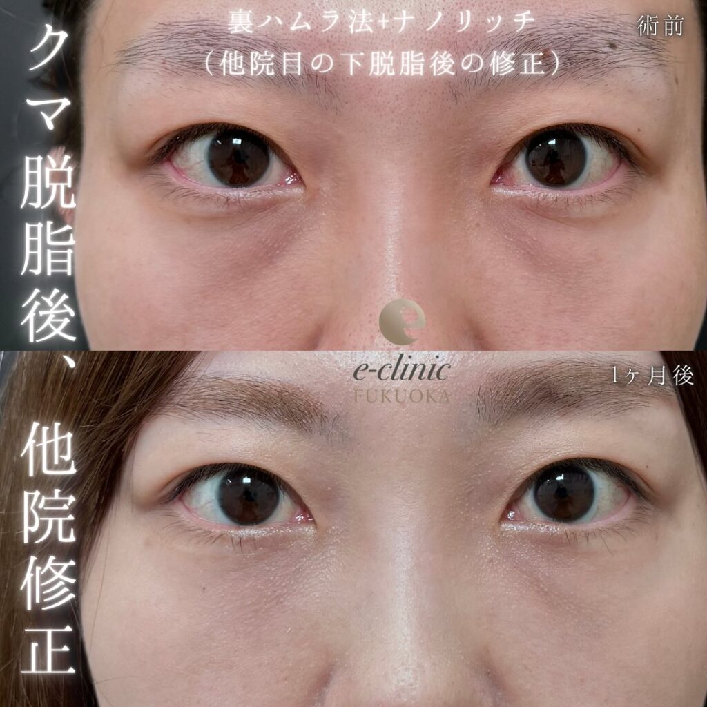 裏ハムラ法とナノリッチの症例写真 (10)