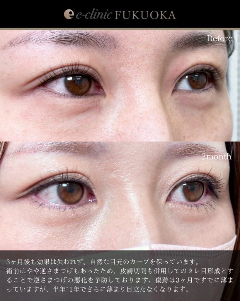 タレ目形成と目尻切開と脱脂とクマ取りの症例写真 (4)