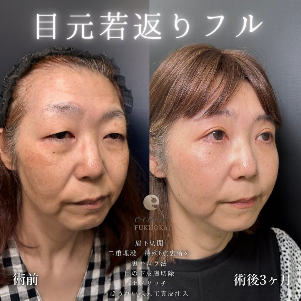 眉下切開と埋没法と裏ハムラ法と目の下の脂肪注入とほうれい線の人工真皮の症例写真 (1)
