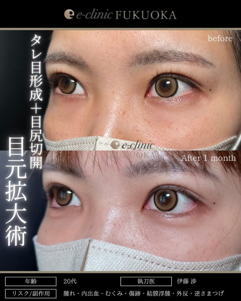 タレ目形成と目尻切開の症例写真 (12)