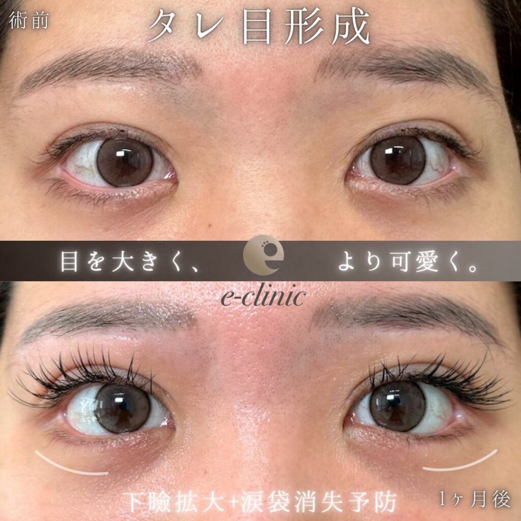 タレ目形成の症例写真 (6)