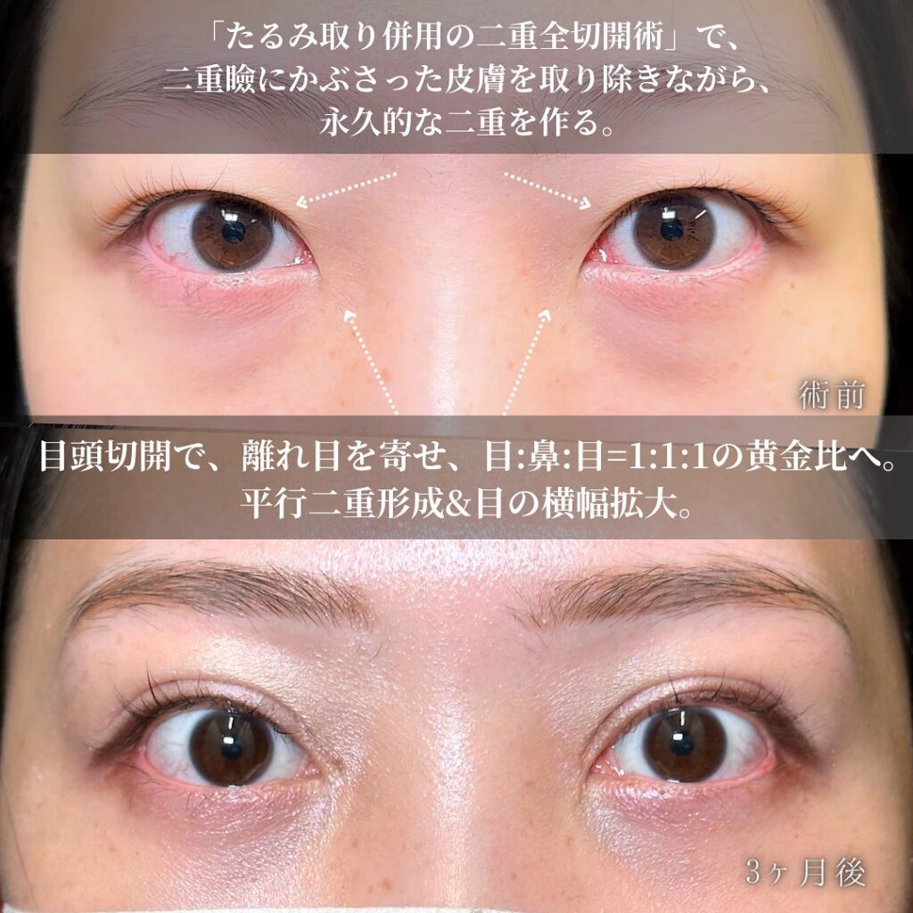 目の全方向拡大と脱脂の症例写真 (4)