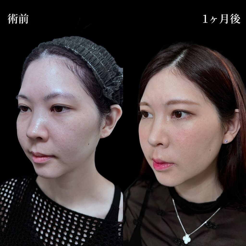 頬と顎下の脂肪吸引の症例写真 (2)