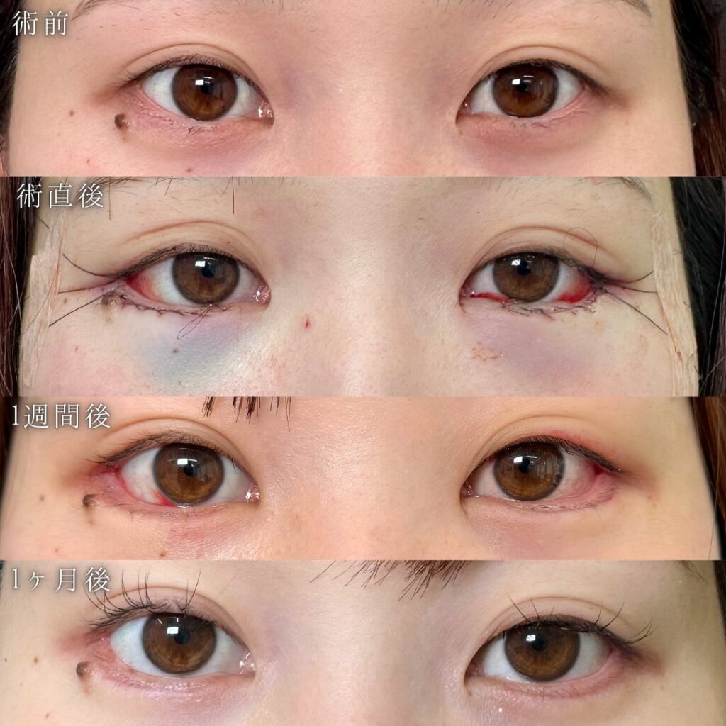 タレ目形成と目尻切開の症例写真 (2)