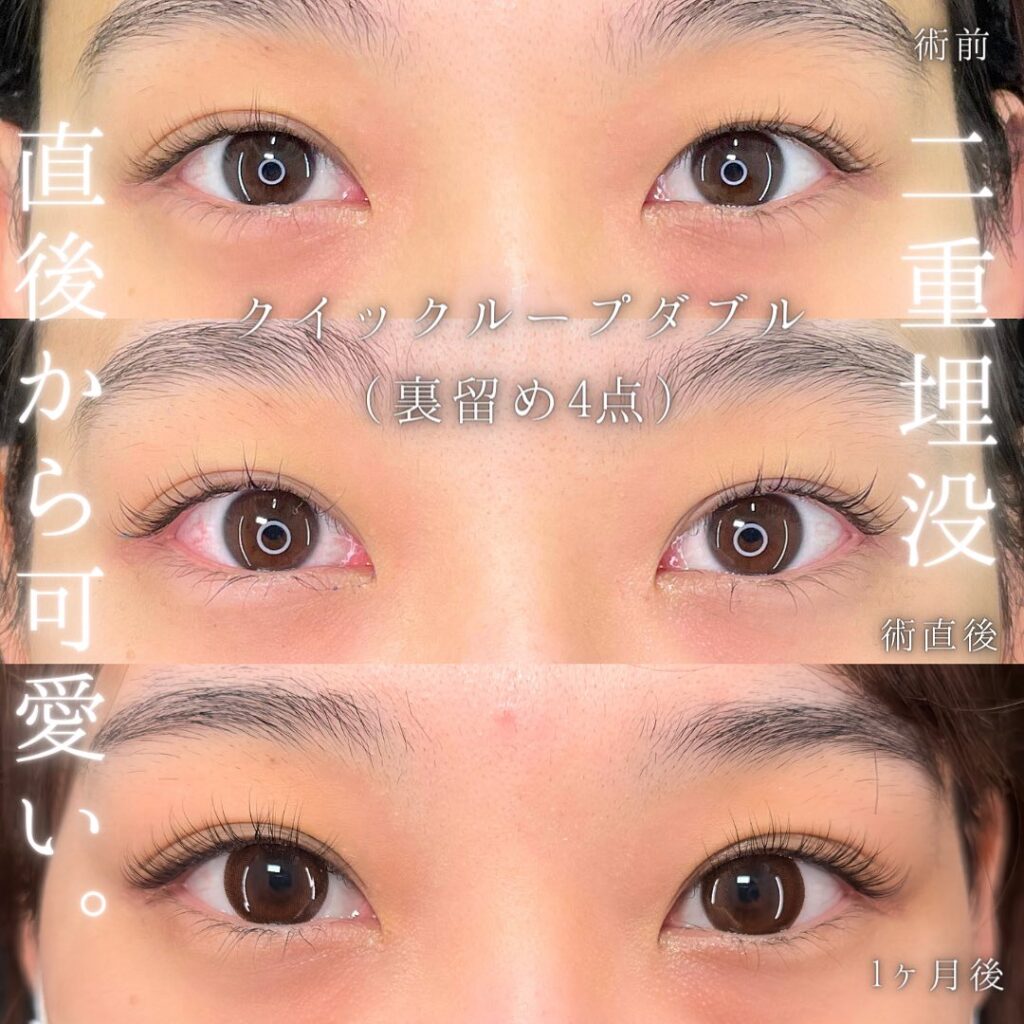 埋没法の症例写真 (8)