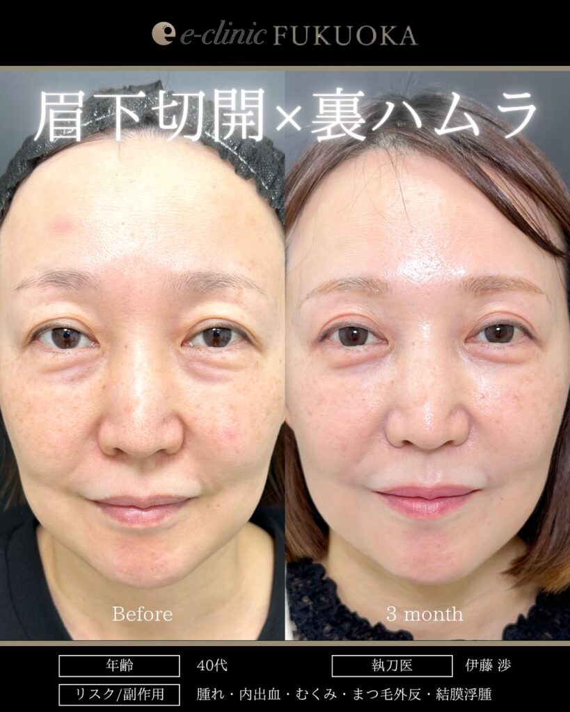 眉下切開と裏ハムラ法の症例写真 (1)