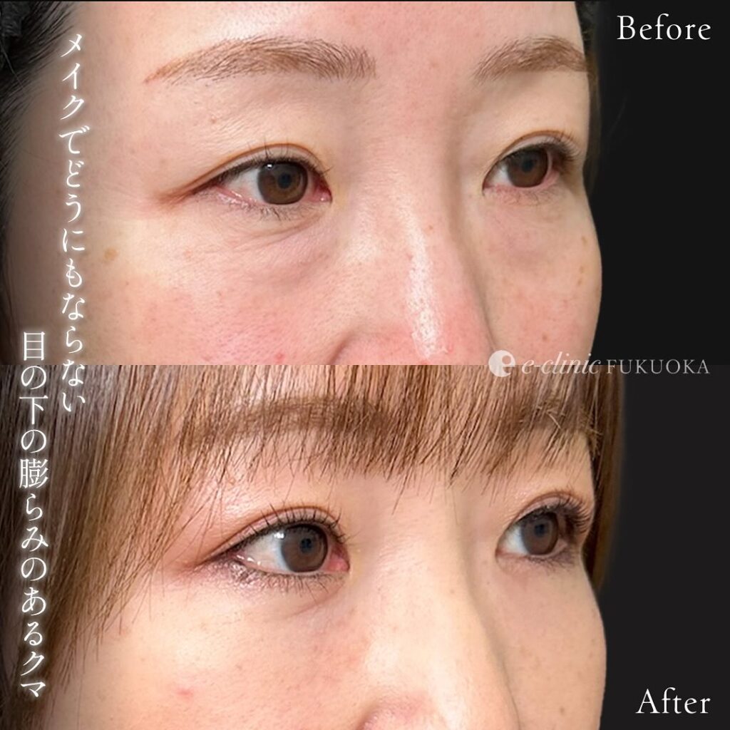 裏ハムラ法の症例写真 (90)