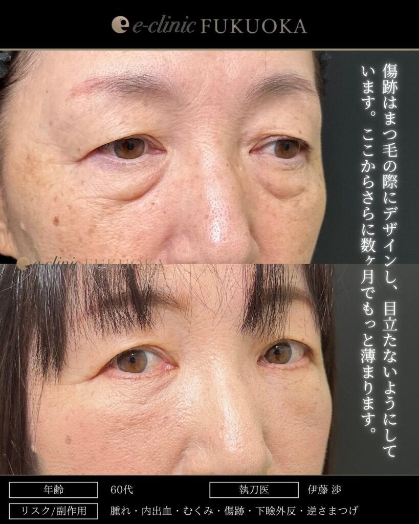 裏ハムラ法と脂肪注入の症例写真 (31)