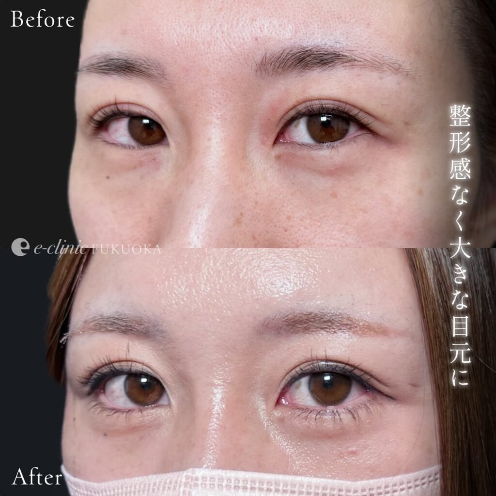 タレ目形成+目尻切開の症例写真 (2)