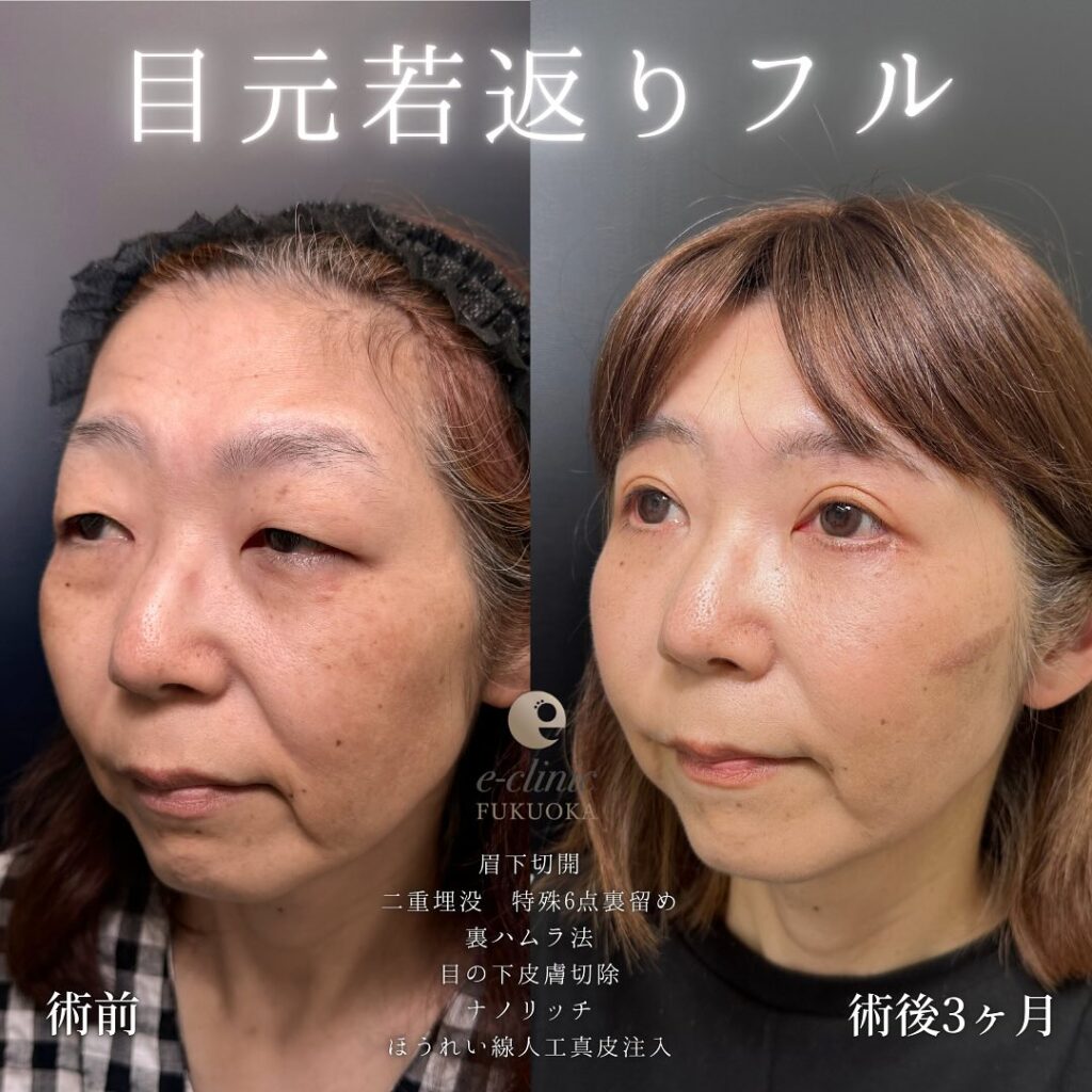 眉下切開と埋没法と裏ハムラ法と目の下の脂肪注入とほうれい線の人工真皮の症例写真 (1)
