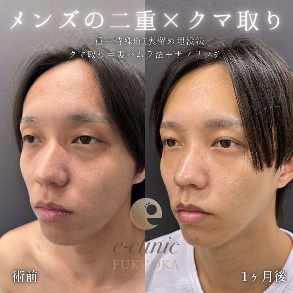 埋没法と裏ハムラ法と脂肪注入の症例写真 (3)