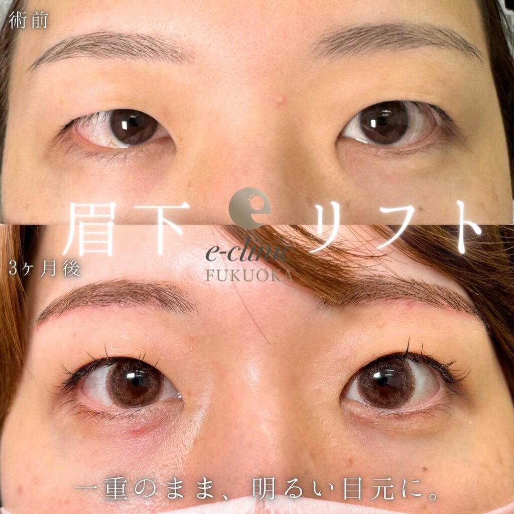 眉下切開の症例写真 (1)