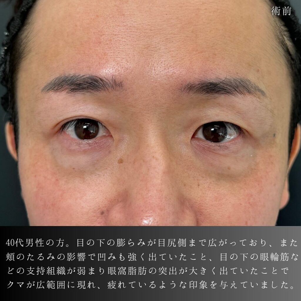 脱脂と脂肪注入の症例写真 (10)