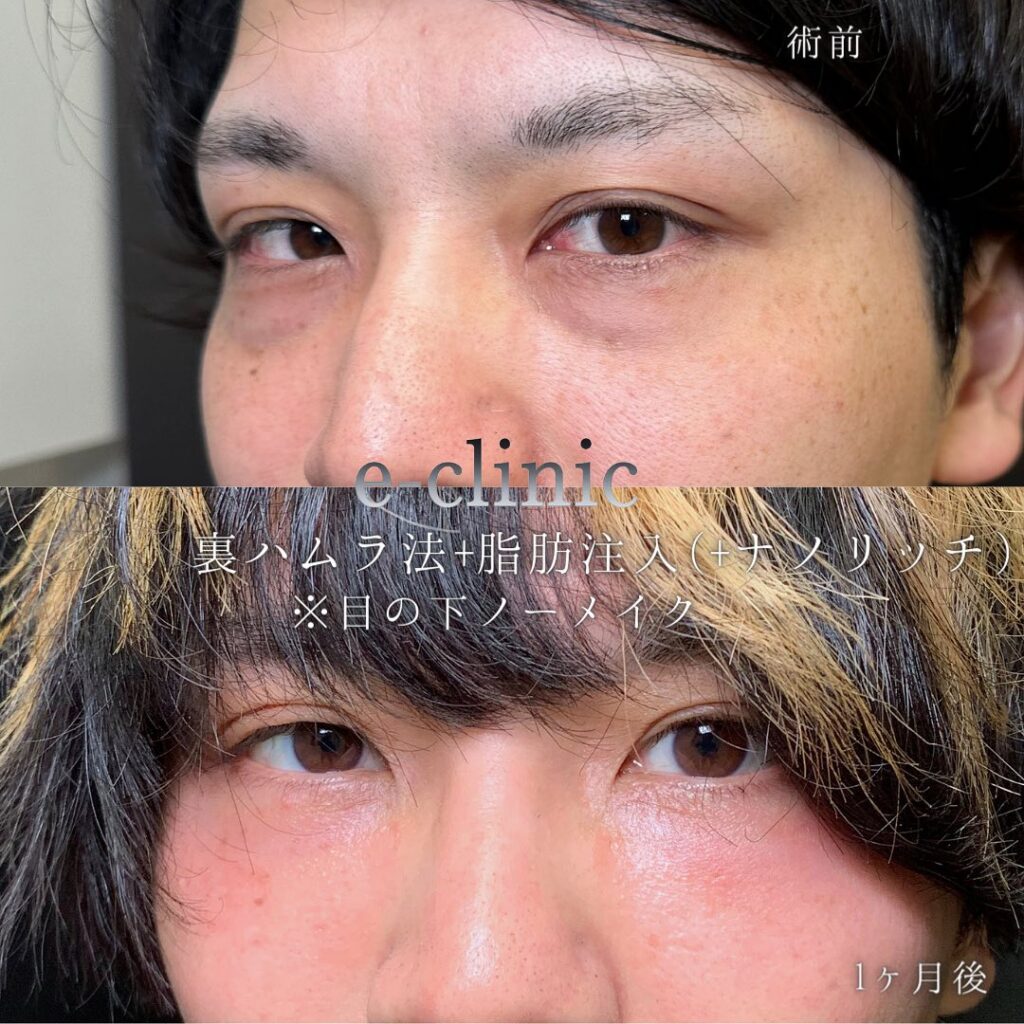 裏ハムラ法と脂肪注入の症例写真 (2)