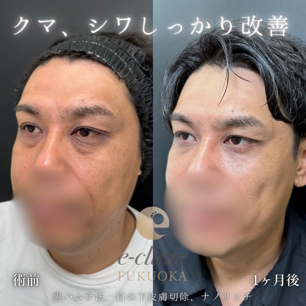 裏ハムラ法と目の下の脂肪注入の症例写真 (6)
