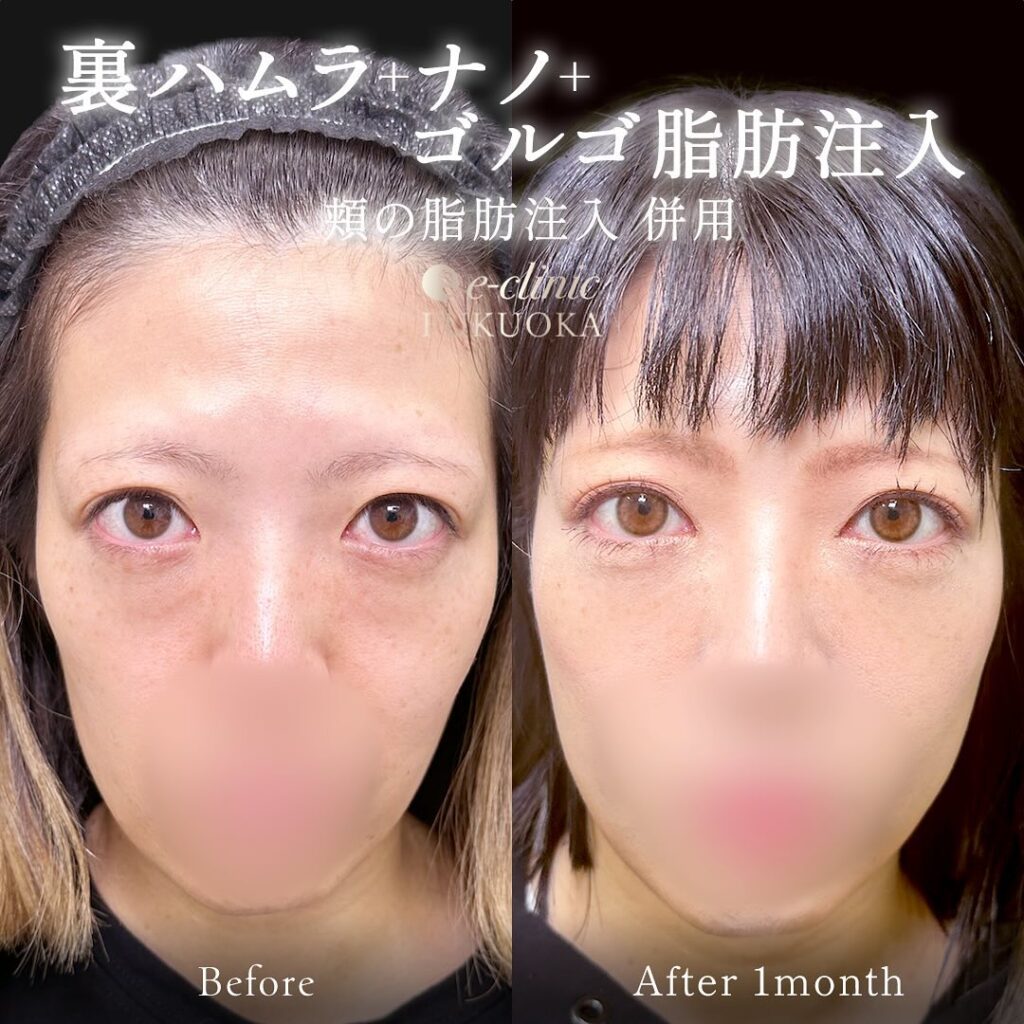 裏ハムラ法と目の下の脂肪注入の症例写真 (7)