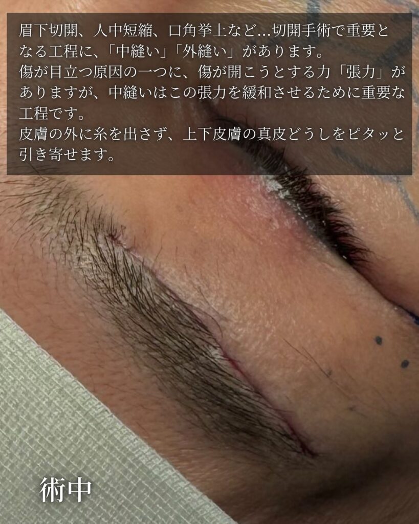 眉下切開の症例写真 (10)