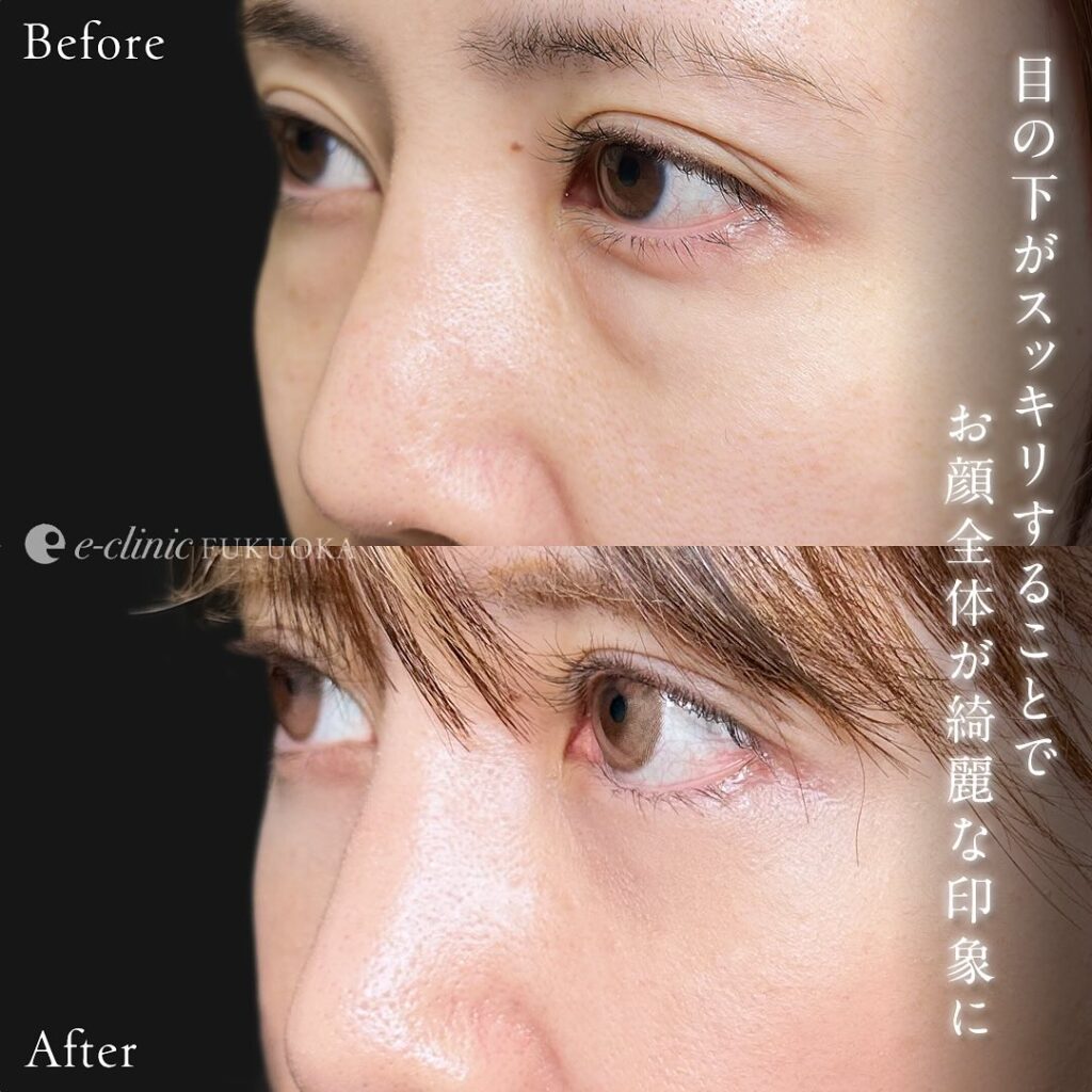 裏ハムラ法の症例写真 (83)