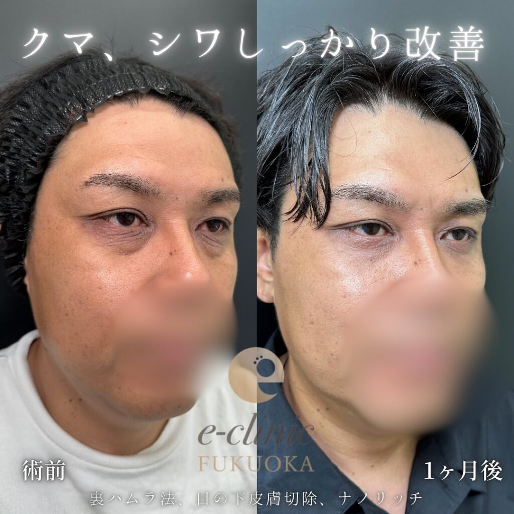 裏ハムラ法と目の下の脂肪注入の症例写真 (5)