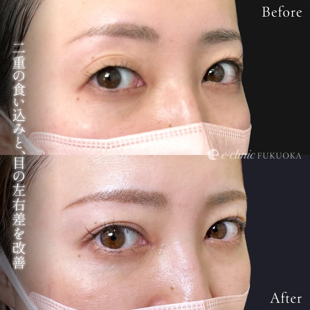 埋没法と他院修正の症例写真 (5)